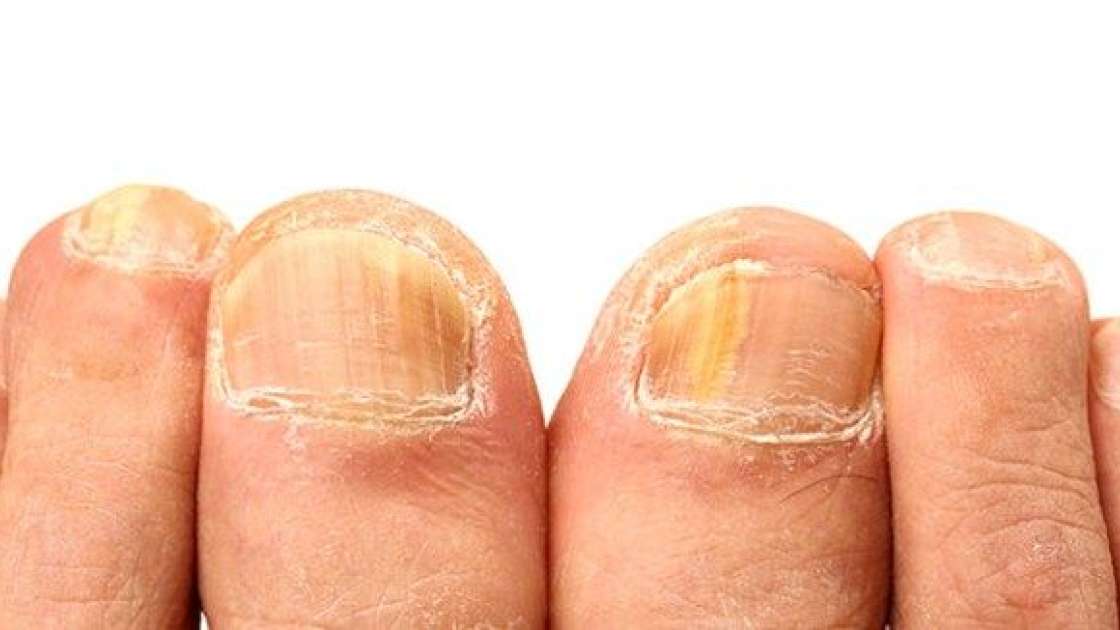 ciuperca unghiilor poate fi vindecată cu acid boric