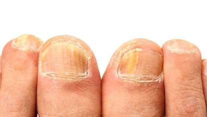 care este pericolul ciupercii unghiilor și picioarelor care sunt simptomele bolii ciupercii unghiilor