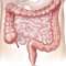 Sindromul de colon (intestin) iritabil: cauze, simptome, tratament