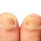 Ciuperca piciorului sau unghiei: cauze, prevenție, remedii naturiste