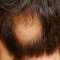 Căderea părului – ce este și cum se poate trata prin remedii naturiste